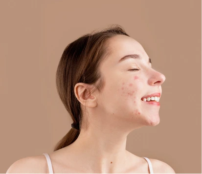 Photo with acne